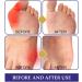 StrongJoints Anti-Bale Toe Patch - Relief for Hallux Valgus & Overlapping Toes (2 Packs - 10 Pieces) | Natural Correction & Comfort - Buy Online on GoSupps.com