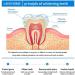 Herbaluxy Tooth Whitening Essence - Natural Teeth Whitening Solution for a Brighter Smile - Buy Online on GoSupps.com