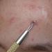 SC-11103-GLD Suvorna Whitehead Remover | Effective Pimple & Cyst Removal Tool for Clear Skin - Buy Online on GoSupps.com