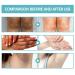 Nigrifree Acanthosis Nigricans Therapy Cream - Dark Spot Corrector & Treatment (1PC) - Buy Online on GoSupps.com