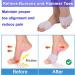 3 Pairs Toe Separators & Metatarsal Pads Soft Breathable Foot Cushions for Blisters Morton s Neuroma Diabetic Feet & Bunion Pain Relief - Perfect for Comfort - Buy Online on GoSupps.com
