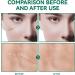 Advanced Silicone Scar Gel Treatment for Surgical, Acne, Stretch Marks & More - 1.7oz (50ml) - Buy Online on GoSupps.com