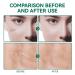 Scar Gel Cream for C-Section Acne Burn Stretch Mark Tummy Tuck Keloid Removal - 50ml - Buy Online on GoSupps.com