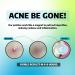 Effective Pimple Patches for Acne Treatment | Hydrocolloid Stickers for Fast Results - Shop Internationally - Buy Online on GoSupps.com