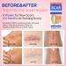 Silicone Scar Removal Sheets for Old & New Scars - 6 Sheets (2 Sizes) - Effective Treatment - Diverse Scars - 5.9 x 1.57 & 2.95 x 1.57 - Buy Online on GoSupps.com