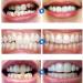 Mxrfactory Dentures Pebble Gel Smile Veneer - Comfort Fit Flex Veneers for Perfect Smile - 12 Pairs for Men & Women - Buy Online on GoSupps.com