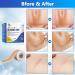 Silicone Scar Sheets & Tape 1.6x120 - Reusable Treatment for C-Section, Burn, Surgery & Acne Scars - Buy Online on GoSupps.com