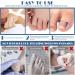 Ingrown Toenail Corrector Patch 300PCs Ingrown Toenail Corrector Strips Toenail Correction Patches Ingrown Toenail Treatment Tool Foot Care No-Glue Painless Toenail Correction Stickers - Buy Online on GoSupps.com