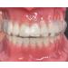 Buy Twin-Splint CMD Rails 2in1 - Effective Aquasplint for Bruxism & Joint Pain Relief | International Shipping - Buy Online on GoSupps.com