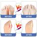Orthopedic Bale Toe Corrector for Men & Women - Big Toe Straighteners for Hallux Valgus Pain Relief (Right) - Day & Night Support - Buy Online on GoSupps.com