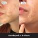 Hero Cosmetics Mighty Patch XL - 10 Large Hydrocolloid Surface Spot Patches | Day & Night Acne Treatment Stickers for Face & Body - Buy Online on GoSupps.com