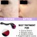 Derma Roller (1.5mm) - Buy Online on GoSupps.com