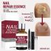 Extra Strong Fungal Nail Treatment - Nail Fungus Remover Kit with File and Brush - 20ml - Buy Online on GoSupps.com