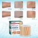 Totclear Silicone Scar Sheets (1.6x12 Roll) - Painlessly Remove Surgery Scars - C-Section Acne Keloid Remover - Buy Online on GoSupps.com