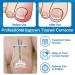 Ingrown Toenail Treatment Kit - 41 Pcs/Set with Professional Tools for Correcting Ingrown Toenails - Includes Corrector Patch, Strips, Podiatry Braces, and Nail Clipper - Buy Online on GoSupps.com