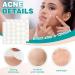 450 Pcs Hydrocolloid Acne Patches | Korean Anti-Acne Spot Treatment - Fast Shipping Worldwide - Buy Online on GoSupps.com