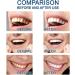 Powerful Teeth Whitening Serum Effectively Removes Surface Plaque Powerful Teeth Whitening Serum Teeth Whitening Serum Removes Various Stains - Buy Online on GoSupps.com