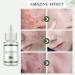Acne Removing Facial Serum Natural Ingredients Professionally Remove Acne Marks For Teens & Adults Anti-acne Moisturizer Acne Removal Serum - Buy Online on GoSupps.com