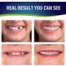 Natural and Comfortable Upper Jaw Dentures - Set of 2, Protect Your Teeth - Buy Online on GoSupps.com