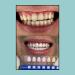 Sol Professional Teeth Whitening Kit with LED Light - Vegan Formula, Non-Sensitive, Fast Whitening, 3 Carbamide Peroxide Gels, Remineralizing Pen, Shade Guide, Case - 50 Sessions - Buy Online on GoSupps.com