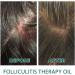 DUBUSH Hair Folliculitis Therapy Oil Natural Therapy Hair And Scalp Oil Nutrition Scalp Oil Folliculitis Scalp Oil For Women Men Protect Scalp Health 1 copy - Buy Online on GoSupps.com