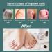 52 Piece Ingrown Toenail Set Ingrown Toenail Lifter for Ingrown Toenails - Buy Online on GoSupps.com