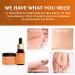 HIBROU Wart Remover Set - Fast-Acting Salicylic Acid Treatment for Plantar and Common Warts - 20g Cream + 10ml Liquid - Buy Online on GoSupps.com