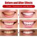 2023 Adjustable Snap-On Dentures: Dental Veneers for Temporary Teeth Restoration - Regain Your Confident Smile! - Buy Online on GoSupps.com