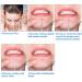 Zuzer Blackhead Remover Kit - 11-Piece Professional Pimple Squeezer Set | Stainless Steel Tools for All Skin Types + 2 Forehead Straps - Buy Online on GoSupps.com