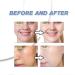 Azelaic Acid Acne Cream for Face Azelaic Acid With Hyaluronic Acids for Face Redness Smooth Anti Acne Breakouts Azelaic Acid Serum Balance Excess Oil & Soothing No Irritation - Buy Online on GoSupps.com