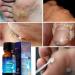 Skin Spot Removal | 10ml Solution for Dissolving Mole Daily Beauty Care for Face Legs Feet Arms Home and Travel Men Women - Buy Online on GoSupps.com