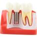 Implant Model Resin Dental Demonstration Demonstration Tooth Model Teeth Model Science Homework for Teaching Model School Dentist - Buy Online on GoSupps.com