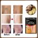 24 PCs Varicose Vein Patch | Remove Spider Veins & Improve Leg Appearance | Enhance Blood Flow & Relieve Inflammation | International Shipping Available - Buy Online on GoSupps.com