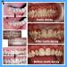Tooth Repair Kit: 3 Moldable Denture Options for Missing or Broken Teeth with Basics+Thermal Beads - Buy Online on GoSupps.com