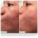 Urban Skin Rx Clear Complexion Acne Serum + Spot Treatment | 5% Benzoyl Peroxide & 5% Glycolic Acid | 1 fl oz - Buy Online on GoSupps.com