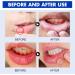 Mouth Ulcer Treatment Spray Oral Ulcer Sprays Ulcer Breath Sprays Canker Relief Spray Canker Sore Treatment Mouth Ulcer Spray Mouth Freshener Spray Breath Spray for Bad Breath Dry Mouth Oral Spray - Buy Online on GoSupps.com