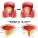 EXQST Natural Herbal Strength Hemorrhoid Capsules - Fast Relief for Men and Women - Buy Online on GoSupps.com