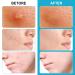 Jonov Acne Pimple Patch - Fast Acting Hydrocolloid Pimple Patches for Night - 18 Blemish Cover Stickers for Face - Buy Online on GoSupps.com
