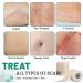 3 Rolls Silicone Scar Sheets(1.6" x 60" Each) Silicone Patches for Scars Reusable Scar Removal Strips for Prevention and Repair - Buy Online on GoSupps.com