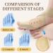 Bunion Correctors for Big Toe Pain Relief | Non-Surgical Hallux Valgus Support for Men & Women - SEBS Cross Strap Separator in Khaki - Buy Online on GoSupps.com
