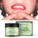 Effective Acne Treatment Face Cream | Herbal Spot Treatment for Teens & Adults | Remove Acne Marks & Moisturize Skin - Buy Online on GoSupps.com