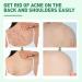 Back Acne Treatment Spray With Herbal Formula 2% Salicylic Acid & Tea Tree Oil - Body Acne Solution 120ml 1PCS - Buy Online on GoSupps.com