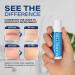 KELODA Keloid Scar Care Butter Stick - Surgical Scars & Keloids Removal Balm with Cocoa & Shea Butter - For Stretch Marks, Acne, Piercings | Coconut & Jojoba Oils - Effective Anti-Scar Treatment - Buy Online on GoSupps.com