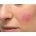 Organic Essential Oils for Rosacea Relief - 28-Day Dual Stage Treatment - Buy Online on GoSupps.com