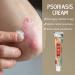 Natural Herbal Anti-Itch Cream for Psoriasis & Eczema - Soothing Moisturizer for Dry, Itchy Skin - Sensitive Skin Lotion (0.7oz) - Buy Online on GoSupps.com