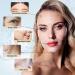 Oldream PDO Thread for Face Lift - Mono Screw Type 30G 38MM 20 Pack - Enhance Your Beauty - Buy Online on GoSupps.com