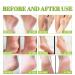 Urea 42% Foot Cream Urea Cream Urea Foot Cream Urea Lotion 42% Urea Cream Foot and Body Care Cracked Heels and Dry Skin Deep Moisturizing Cracked Heel Repair Cream For Feet - Buy Online on GoSupps.com