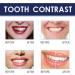 Teeth Whitening Pen - Pain-Free Tooth Bleaching Travel Size (5pc) | Quick & Gentle Tooth Whitening - Buy Online on GoSupps.com