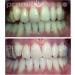 Premium Home Teeth Whitening Kit - Fast Safe & Effective Results | International Shipping Available - Buy Online on GoSupps.com