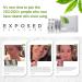 Exposed Skin Care Acne Treatment Kit - Salicylic Acid Face Wash, Benzoyl Peroxide Treatment Serum - Natural Solution for All Skin Types - 5 Piece Set - Buy Online on GoSupps.com
